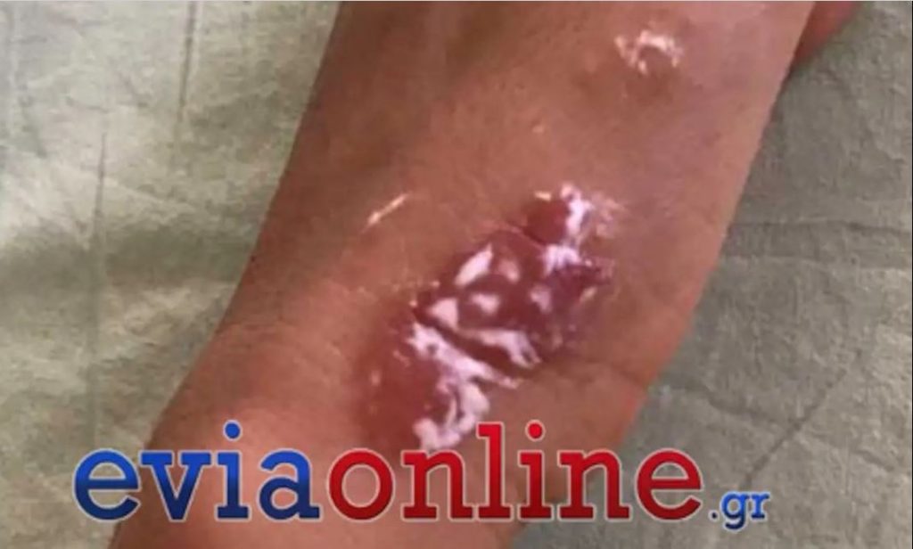 «Κύμα» ανησυχίας για την απότομη αύξηση των μωβ μεδουσών στην Εύβοια (φωτο)