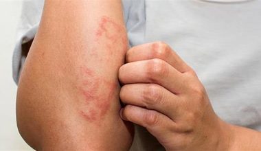 Έκζεμα ή ξηροδερμία; – Δείτε πώς θα τα ξεχωρίσετε και πώς θα τα αντιμετωπίσετε