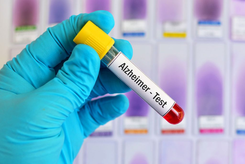 Ο FDA ενέκρινε νέα εξέταση αίματος για τη νόσο Αλτσχάιμερ – Τι ξέρουμε για την «Elecsys»