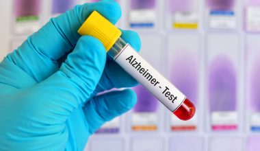 Ο FDA ενέκρινε νέα εξέταση αίματος για τη νόσο Αλτσχάιμερ – Τι ξέρουμε για την «Elecsys»