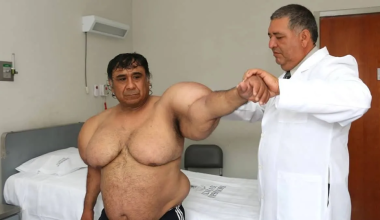 «Είμαι παραμορφωμένος, αλλά ζωντανός»: Ο δύτης από το Περού που έχει «φυσαλίδες αζώτου» στο σώμα του (βίντεο)