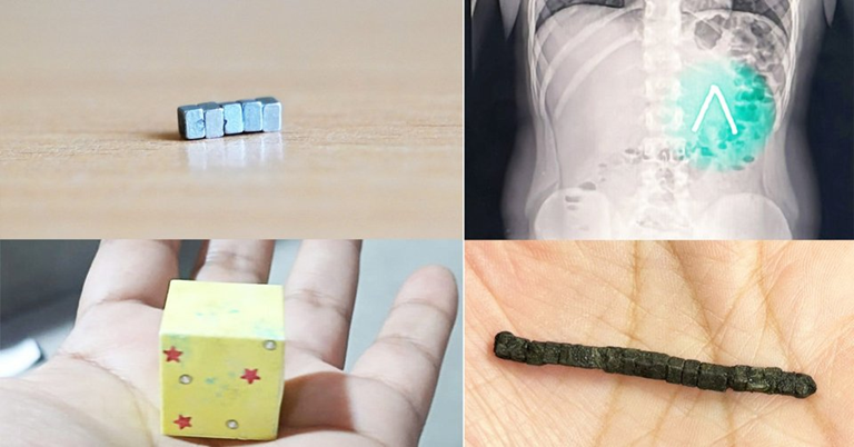 Περού: 9χρονη κατάπιε πάνω από 20 μαγνήτες μέσα σε μια εβδομάδα και κατέληξε στο χειρουργείο