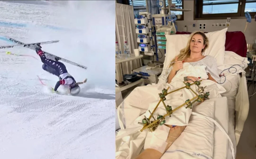 Πέμπτο χειρουργείο για τη Λίντσεϊ Βον: Η ακτινογραφία της κνήμης της με λάμες και δεκάδες βίδες (φώτο)