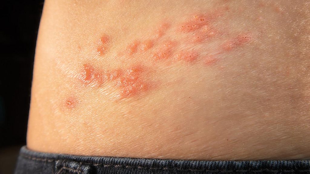 Έρπης ζωστήρας: Δείτε ποιοι κινδυνεύουν περισσότερο και πώς εκδηλώνεται